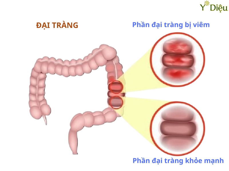 Viêm Đại Tràng Cấp Tính: Nguyên Nhân Triệu Chứng Phòng Ngừa